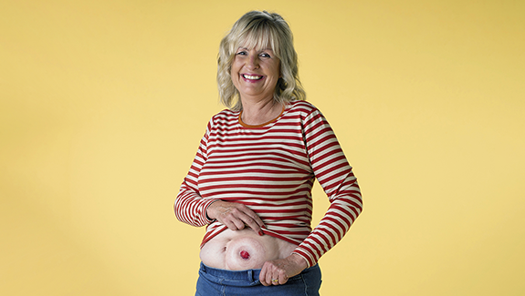 smiling-woman-showing-her-ostomy-Jen