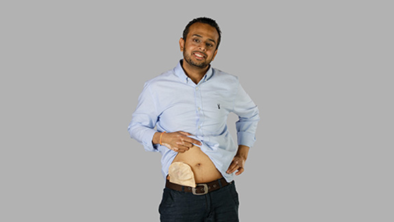 Stoma-Super-Dad-Hiren-Focuses-On-His-Family_575x325