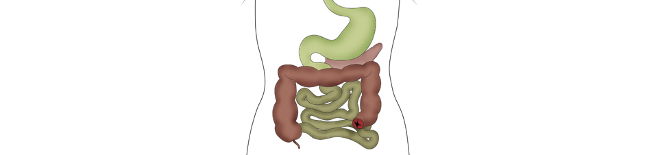 Learning Centre Types of Stoma